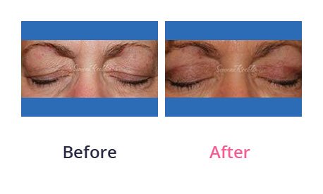 Eyelid-Surgery-img-5
