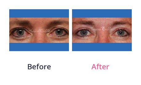 Eyelid-Surgery-img-50