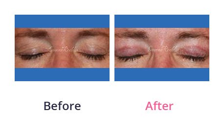 Eyelid-Surgery-img-51
