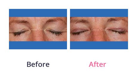 Eyelid-Surgery-img-6