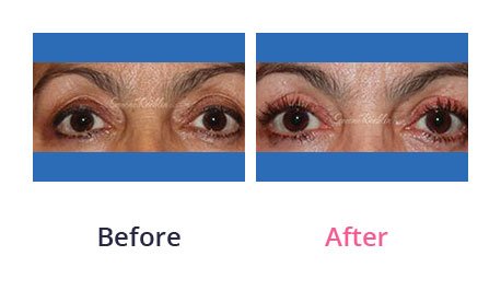 Eyelid-Surgery-img-8