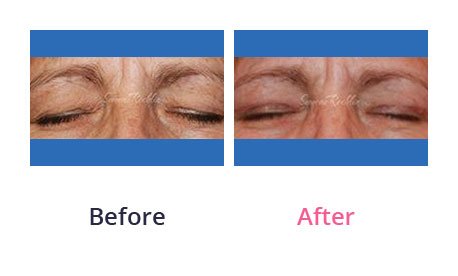 Eyelid-Surgery-img-9