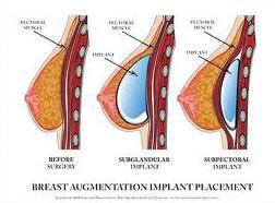 breast augmentation implant placement