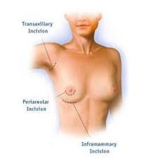 breast implant incision location