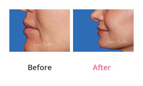 Lip-Augmentation-img-1