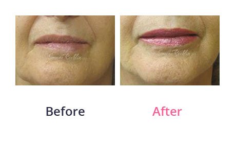 Lip-Augmentation-img-10
