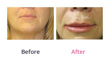 Lip-Augmentation-img-11