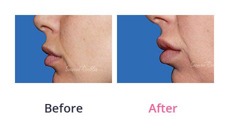 Lip-Augmentation-img-12