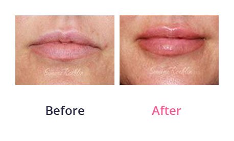 Lip-Augmentation-img-13