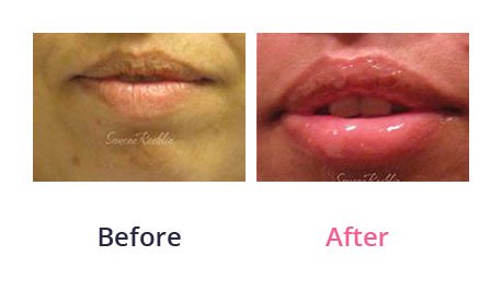Lip-Augmentation-img-14