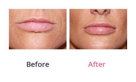 Lip-Augmentation-img-15