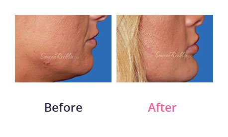 Lip-Augmentation-img-16