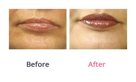Lip-Augmentation-img-17