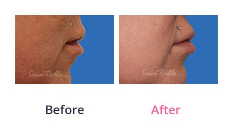 Lip-Augmentation-img-18