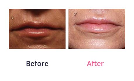 Lip-Augmentation-img-19