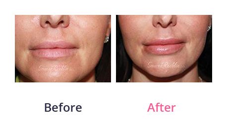 Lip-Augmentation-img-2