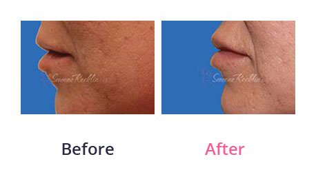 Lip-Augmentation-img-20