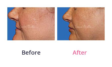 Lip-Augmentation-img-21