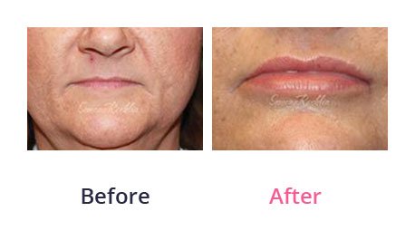 Lip-Augmentation-img-22
