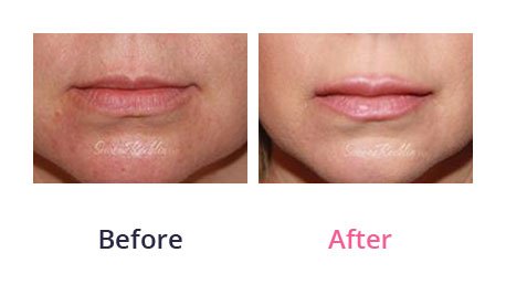 Lip-Augmentation-img-23