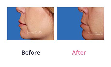 Lip-Augmentation-img-24