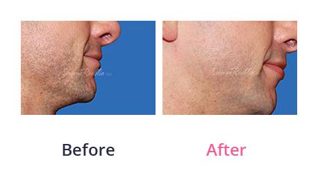 Lip-Augmentation-img-25