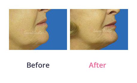 Lip-Augmentation-img-26