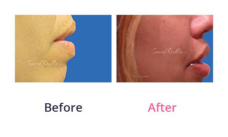 Lip-Augmentation-img-27