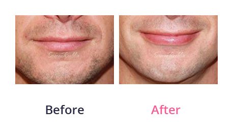 Lip-Augmentation-img-3