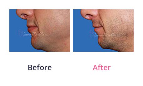 Lip-Augmentation-img-4
