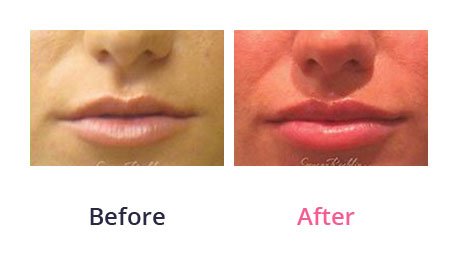 Lip-Augmentation-img-5