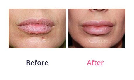Lip-Augmentation-img-6