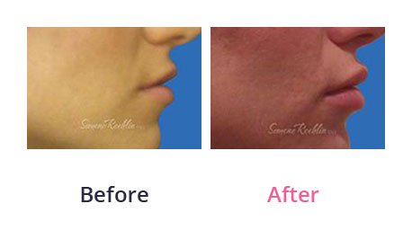 Lip-Augmentation-img-7