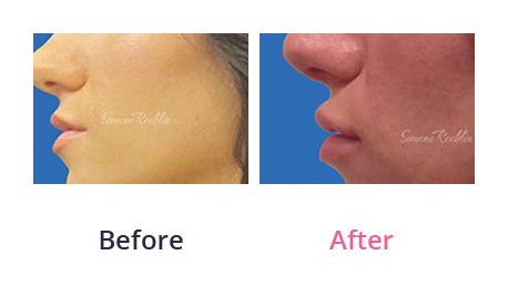 Lip-Augmentation-img-8