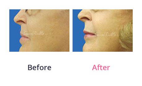 Lip-Augmentation-img-9
