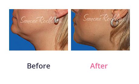 Liposuction-img-1