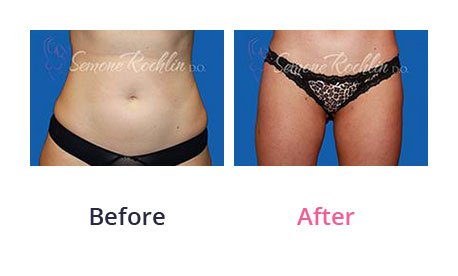 Liposuction-img-10