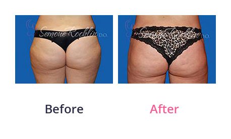Liposuction-img-11