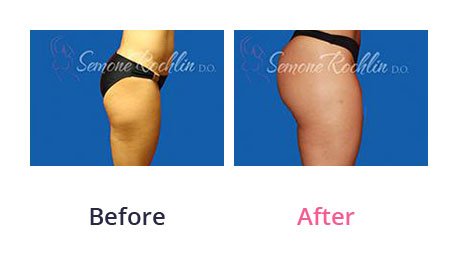 Liposuction-img-12