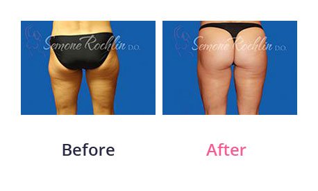 Liposuction-img-13