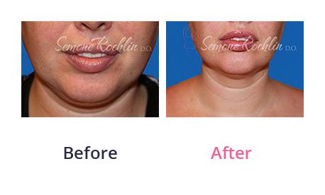 Liposuction-img-14