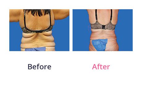 Liposuction-img-15