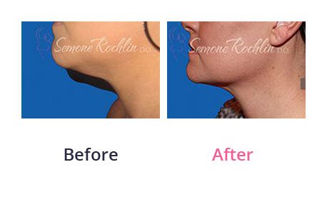 Liposuction-img-16