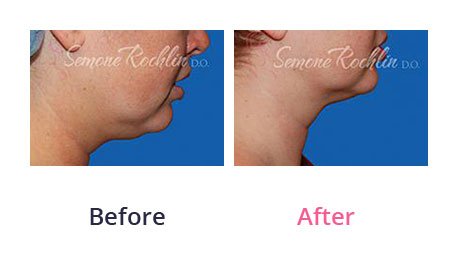Liposuction-img-17