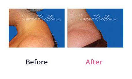Liposuction-img-18