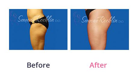 Liposuction-img-19