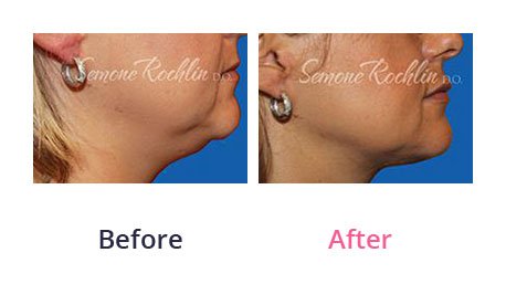 Liposuction-img-2