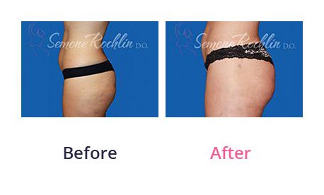 Liposuction-img-20