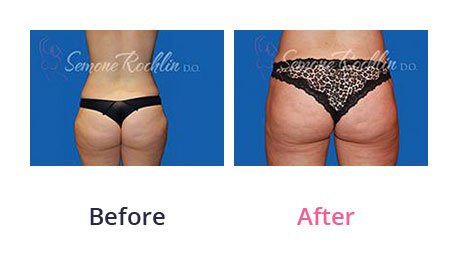 Liposuction-img-21