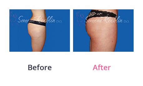Liposuction-img-22